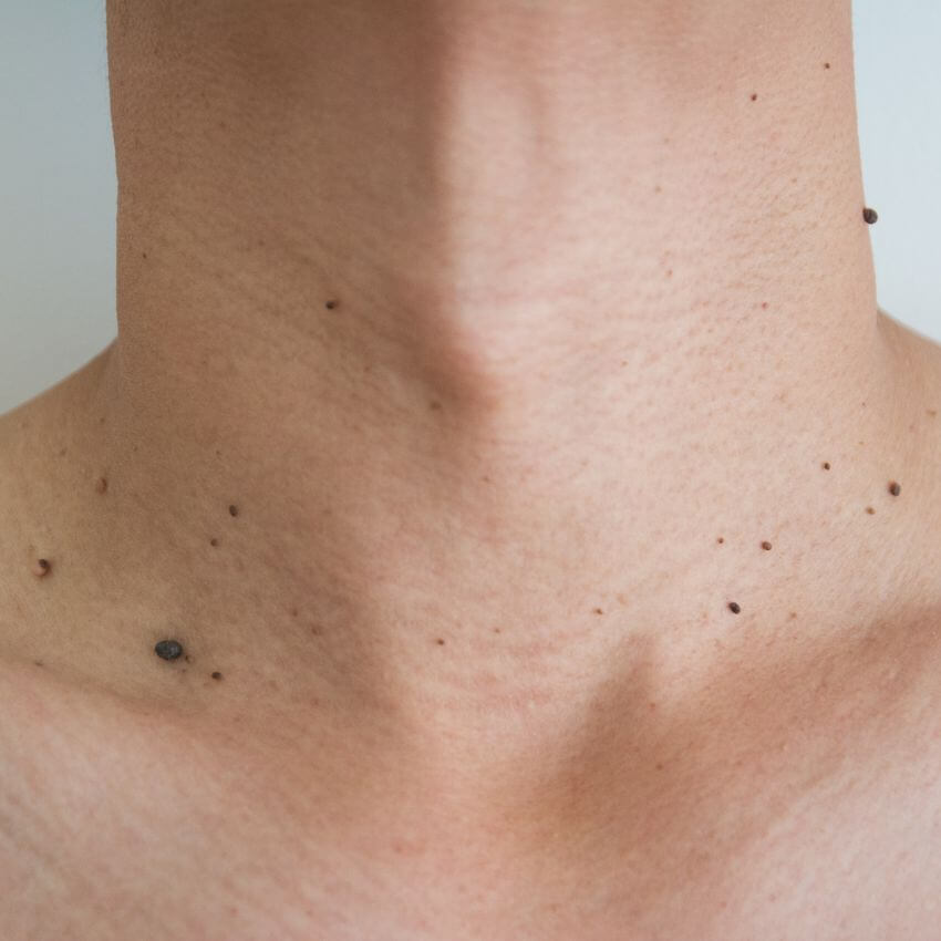 skin tag removal