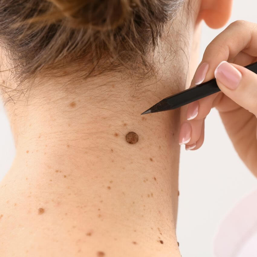 mold and skin tags removals in houston